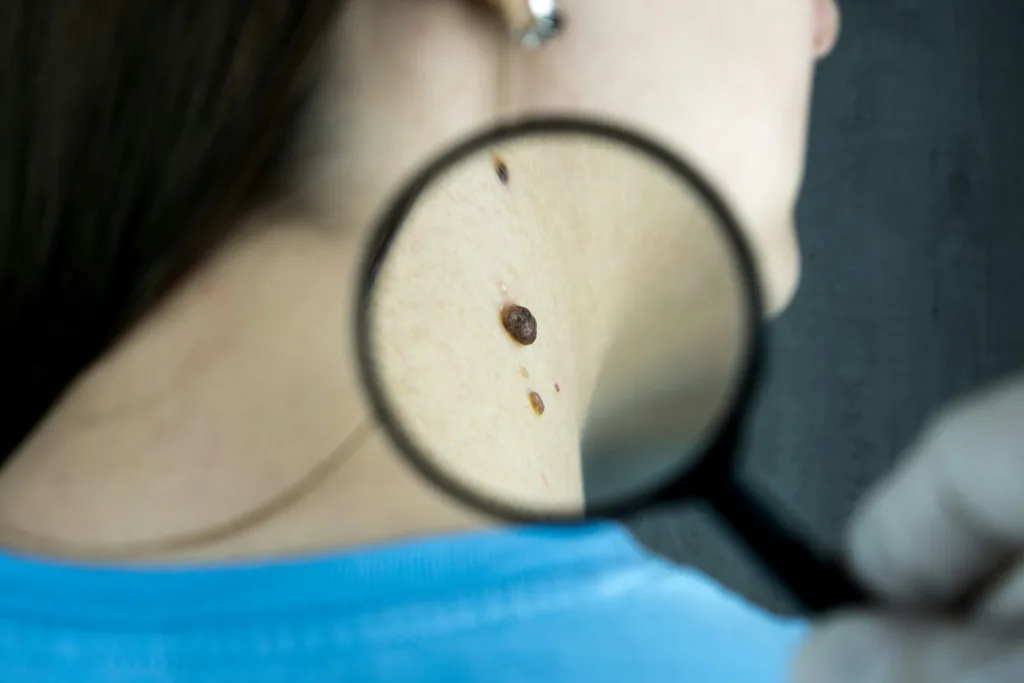 Close-up of a person’s neck with a large brown mole being viewed through a magnifying glass.